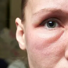 Un visage gonflé, peut-être à cause d'une allergie. On cherche un remède de grand-mère pour soulager cette paupière enflée.