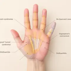 Anatomie de la main droite montrant les causes de douleur : syndrome de De Quervain, contracture de Dupuytren, syndrome du canal carpien, arthrose.