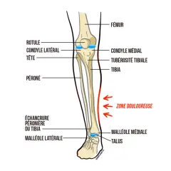 Schéma anatomique du tibia et du péroné, montrant la zone douloureuse typique de la périostite tibiale, suggérant des pistes pour le traitement.