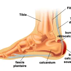 Anatomie du pied montrant le calcanéum, le fascia plantaire et le tendon d'Achille. Une bursite rétrocalcanéenne peut causer une tendinite sous le talon.