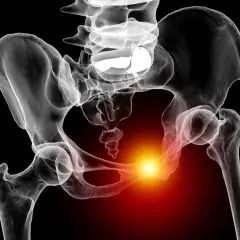 Radiographie du bassin humain montrant une zone de douleur vive au niveau de la symphyse pubienne, suggérant une douleur symphyse pubienne sans grossesse.