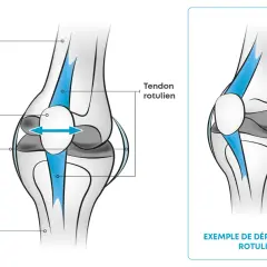 Illustration du genou : Fémur, rotule, ligaments, tibia. Une flèche bleue montre un déplacement rotulien. Que faire si mes genoux lâchent quand je marche ?