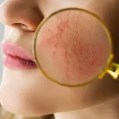 Gros plan sur une peau rougie, examinée à la loupe. Une approche de rosacée traitement naturel pour apaiser les rougeurs.