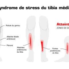 Schéma illustrant le syndrome de stress du tibia médial, avec des zones de douleur indiquées sur le tibia, pouvant signaler une fracture de fatigue tibia.