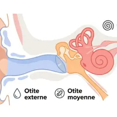 Schéma de l'oreille montrant otite externe, moyenne et interne. Des remèdes naturels pour l'otite peuvent aider.