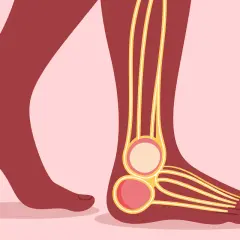 Illustration d'un pied montrant les nerfs, avec une coupe transversale de la cheville. Peut illustrer la douleur nerf plantaire latéral.