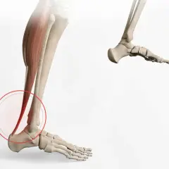 Illustration médicale montrant une calcification du tendon d'Achille, avec une zone rouge entourant la zone affectée.