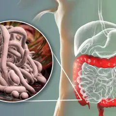 Gros plan sur des parasites intestinaux, avec une illustration du système digestif humain. Une vision pour un vermifuge humain naturel.