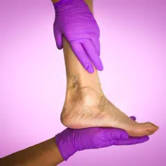 Mains gantées de violet soutiennent une jambe montrant des signes de mauvaise circulation sanguine.