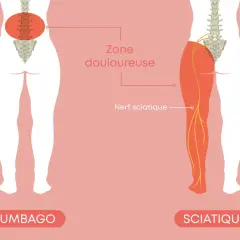 Illustration montrant le nerf sciatique et la zone douloureuse d'une sciatique jambe droite symptôme.