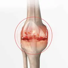 Illustration d'un genou montrant les symptômes d'une crise d'arthrose : cartilage usé et inflammation.