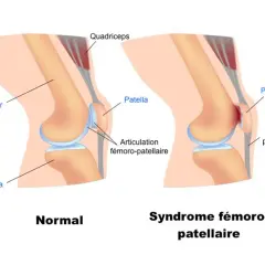 Comparaison d'un genou normal et d'un genou atteint du syndrome fémoro-patellaire, expliquant la douleur genou en descente.