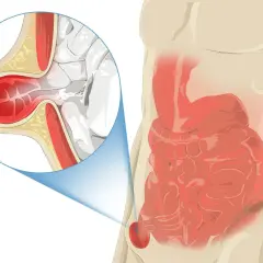 Illustration d'une hernie inguinale, montrant l'intestin sortant par une faiblesse de la paroi abdominale. Le pubis gonflé est une cause de douleur.