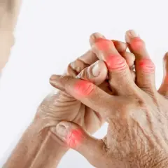 Mains montrant des articulations rouges et enflammées, symptomatiques d'une arthrose du doigt, même chez les jeunes.