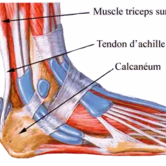 Anatomie du pied montrant le muscle triceps sural, le tendon d'Achille et le calcanéum. Illustration d'une tendinite du tendon d'Achille.