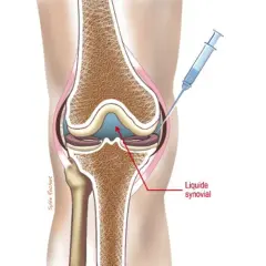 Illustration d'une injection d'acide hyaluronique dans le genou. Avis sur cette procédure pour soulager la douleur.