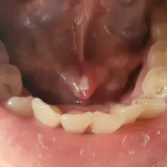 Un petit bouton blanc est visible sous la langue, près de la base. Les dents du bas sont également visibles.