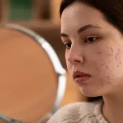 Jeune femme examinant son visage dans un miroir, préoccupée par l'acné et les imperfections de sa peau. Le zinc pourrait aider.