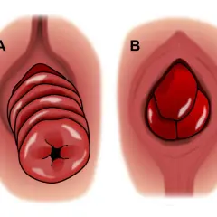 Illustration A montre un prolapsus rectal en plusieurs couches, tandis que B illustre un prolapsus d'organe chez l'homme.