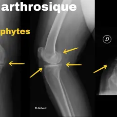 Radiographies du genou montrant un arthrose genou stade 4 avec ostéophytes marqués, rétrécissement de l'espace articulaire et déformations osseuses.