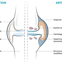 Comparaison d'une articulation saine et d'une articulation atteinte d'arthrose, montrant les symptômes : cartilage modifié, kystes, hypertrophie synoviale.