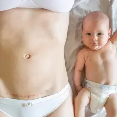 Ventre après césarienne, avec une cicatrice visible, à côté d'un bébé souriant.