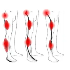 Schéma montrant les zones de douleur du nerf sciatique, incluant le mollet, avec des points rouges indiquant l'inflammation.