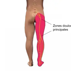Douleur irradiant de la fesse, le long de la cuisse, jusqu'au pied. Zones douloureuses principales.