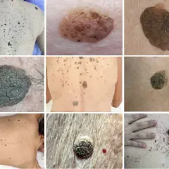 Diverses lésions cutanées, dont des kératoses séborrhéiques. Recherche d'un traitement naturel pour ces affections.