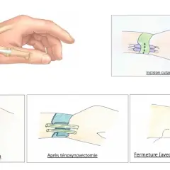 Illustrations montrant la zone de souffrance tendineuse au poignet, les étapes d'une ténosynovectomie et la fermeture. Ces symptômes de tendinite au poignet peuvent nécessiter une intervention.