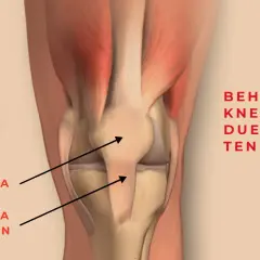 Anatomie du genou montrant le tendon derrière le genou, expliquant la douleur due à la tendinite.
