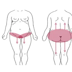 Schéma montrant les zones de douleur pelvienne chez la femme, avec des flèches indiquant la direction de la douleur.
