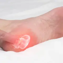 Application de crème sur un pied souffrant d'aponévrosite plantaire. L'alimentation joue un rôle clé dans la guérison.