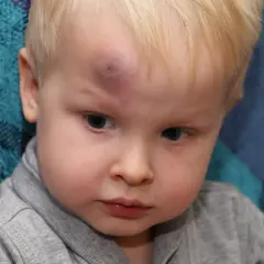 Petit garçon avec un hématome boule dure sur le front, résultat d'une chute.