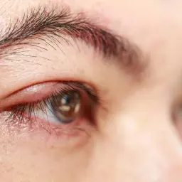 Gros plan sur un œil présentant un orgelet rouge et gonflé sur la paupière. Une solution naturelle pour le traitement de l'orgelet est recherchée.