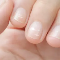 Plusieurs ongles présentent une tache blanche, comme des nuages dans le ciel, indiquant une possible carence.