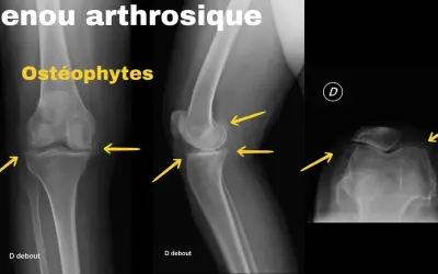 Radiographies du genou montrant un arthrose genou stade 4 avec ostéophytes marqués, rétrécissement de l'espace articulaire et déformations osseuses.