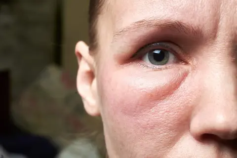 Un visage gonflé, peut-être à cause d'une allergie. On cherche un remède de grand-mère pour soulager cette paupière enflée.