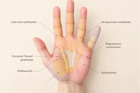 Anatomie de la main droite montrant les causes de douleur : syndrome de De Quervain, contracture de Dupuytren, syndrome du canal carpien, arthrose.