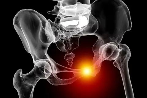 Radiographie du bassin humain montrant une zone de douleur vive au niveau de la symphyse pubienne, suggérant une douleur symphyse pubienne sans grossesse.