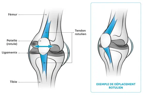 Illustration du genou : Fémur, rotule, ligaments, tibia. Une flèche bleue montre un déplacement rotulien. Que faire si mes genoux lâchent quand je marche ?