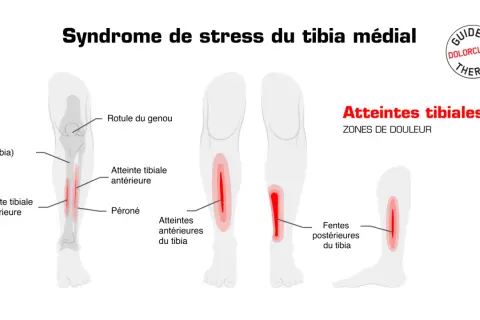 Schéma illustrant le syndrome de stress du tibia médial, avec des zones de douleur indiquées sur le tibia, pouvant signaler une fracture de fatigue tibia.