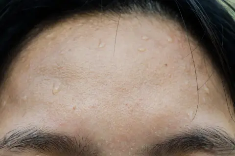 Gouttes de sueur sur le front, signe de transpiration excessive du visage.