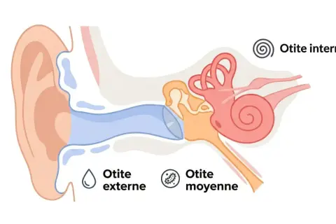 Schéma de l'oreille montrant otite externe, moyenne et interne. Des remèdes naturels pour l'otite peuvent aider.