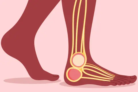 Illustration d'un pied montrant les nerfs, avec une coupe transversale de la cheville. Peut illustrer la douleur nerf plantaire latéral.