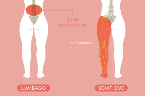 Illustration montrant le nerf sciatique et la zone douloureuse d'une sciatique jambe droite symptôme.