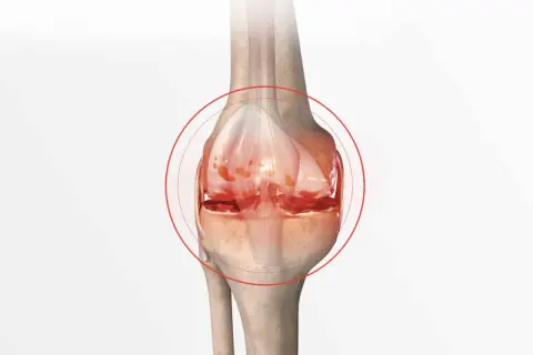 Illustration d'un genou montrant les symptômes d'une crise d'arthrose : cartilage usé et inflammation.