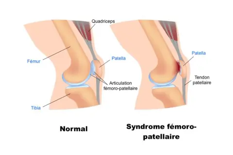 Comparaison d'un genou normal et d'un genou atteint du syndrome fémoro-patellaire, expliquant la douleur genou en descente.