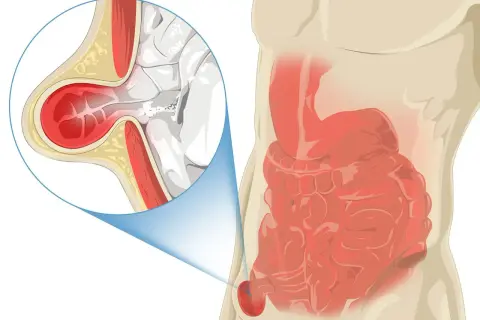 Illustration d'une hernie inguinale, montrant l'intestin sortant par une faiblesse de la paroi abdominale. Le pubis gonflé est une cause de douleur.