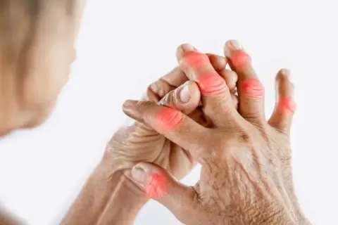 Mains montrant des articulations rouges et enflammées, symptomatiques d'une arthrose du doigt, même chez les jeunes.